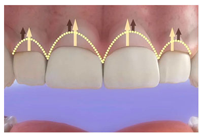 Gingivectomía