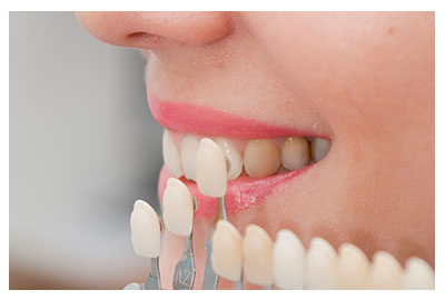 Carillas dentales