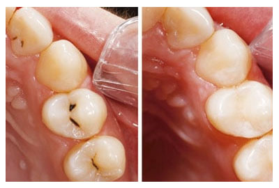 Caries y empaste dental