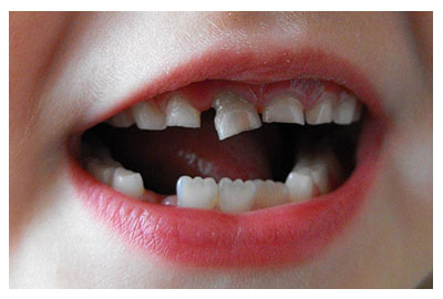 Traumatismos en dientes de leche