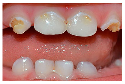 Caries en dientes de leche