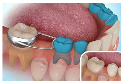 Mantenedor de espacio dental