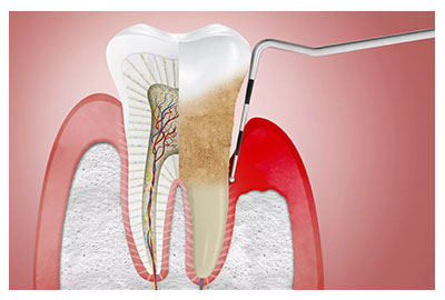 Tratamiento de la gingivitis